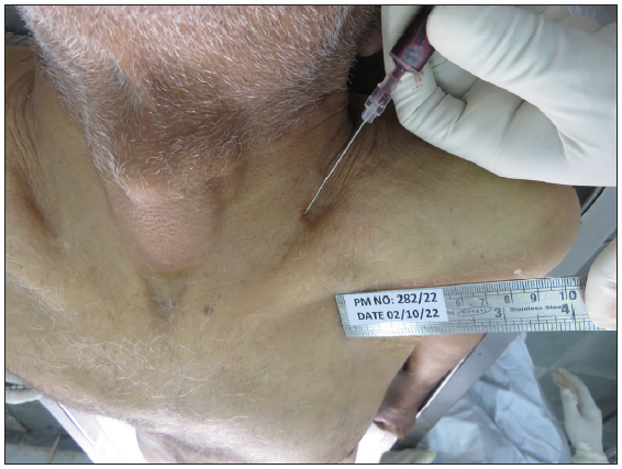 Showing the use of a syringe with a Quincke needle attached for collecting blood samples from the left side subclavian vein through the supraclavicular approach.