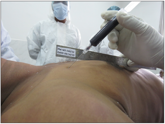 Showing the use of a syringe with a Quincke needle attached for collecting blood samples from the right side subclavian vein through the infraclavicular approach.