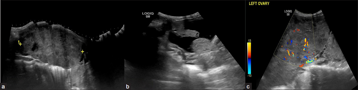 A 23-year-old female with complaints of abdominal distension for 3 months. CA-125 level – 650 U/ml. On USG, A relatively defined multi-lobulated hypoechoic solid lesion with lobular margins in the left adnexa (a) with mild ascites (b), and left pleural effusion. (c) On Doppler the color score is 3. The above features are suggestive of the Ovarian-Adnexal Reporting and Data System ORADS 5 lesion. On histopathology, the above lesion is suggestive of dysgerminoma.