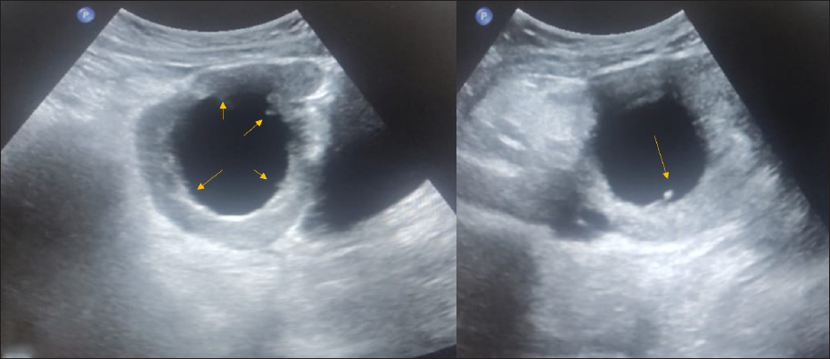 An 18-year-old female with complaints of abdominal pain for ten days associated with nausea and vomiting. CA-125 level was normal. On USG abdomen– Unilocular cyst of size 6.5 × 6.6 cm noted in the right adnexa with an irregular inner wall and echogenic papillary projection at least 5 in number (arrows), not showing any vascularity on color doppler- ORADS 4. On MRI, pelvis features were suggestive of ovarian torsion.