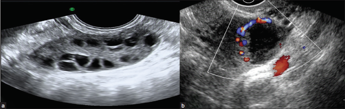 (a) Grey-scale ultrasound image reveals a normal ovary with multiple peripheral follicles and homogeneous echotexture with a central echogenic medulla in a premenopausal female. (b) Color Doppler image shows a thick-walled cystic lesion with crenulated inner walls, few internal echoes, and peripheral vascularity in premenopausal females suggestive of corpus luteal cyst.