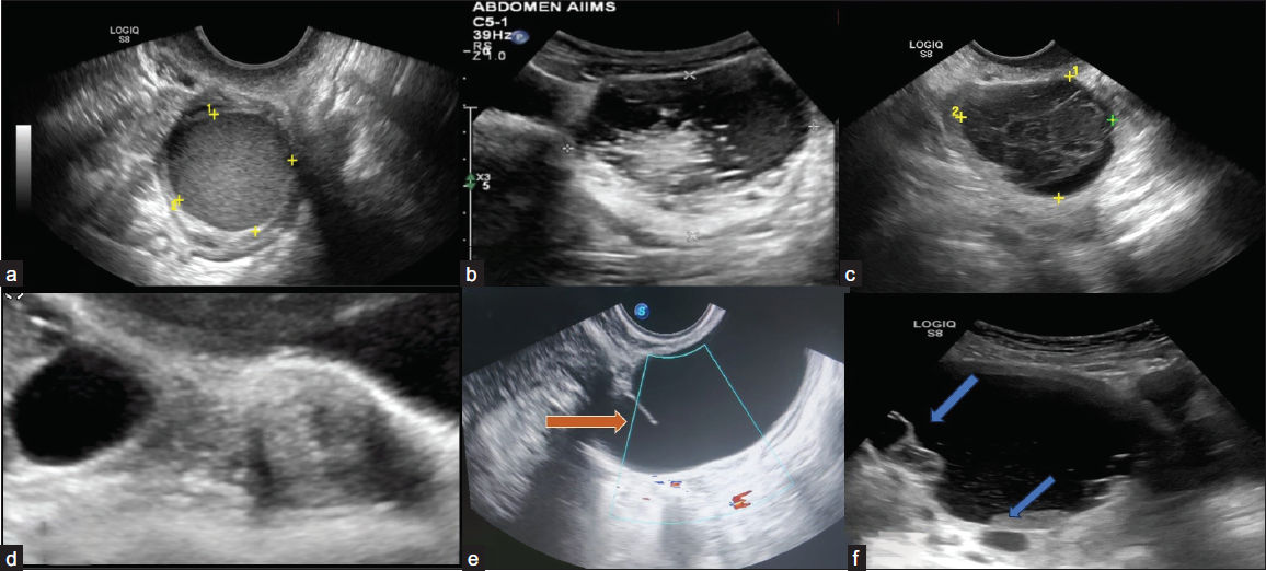 Ultrasonography (USG) images of classically benign lesions. (a) Ultrasound image shows endometrioma characterized by a unilocular cyst within the ovary with homogeneous and evenly dispersed echoes throughout the entire cyst. (b) Grey-scale ultrasound images each show a typical dermoid cyst demonstrating a hyperechoic component with shadowing. Another typical feature of a dermoid cyst is hyperechoic lines and dots representing coiled hair. (c) Typical hemorrhagic cyst. A unilocular cyst with an internal reticular pattern of fine intersecting lines. (d) A simple cyst separates from the adjacent ovary, indicating para ovarian cyst. (e) Grey-scale longitudinal ultrasound image shows a tubular-shaped, fluid-filled structure with no internal echoes. An incomplete septation (arrow) representing a fold is seen, a feature of a typical hydrosalpinx. (f) Ultrasound image shows a peritoneal inclusion cyst characterized by unilocular fluid collection that conforms to adjacent pelvic organs with an ovary at the margin (upper arrow). There is a lack of a discrete limiting wall, no mural nodularity, and minimal internal debris (lower arrow).