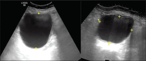 Ultrasonography images show unilocular cystic adnexal lesion. The average of linear dimension in three planes is used for interval change and the largest dimension for risk stratification.