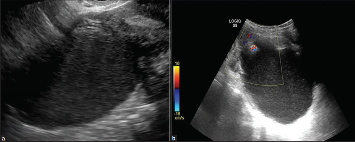 Ultrasonography (USG) images depicting inner margins or walls of cystic lesions. (a) USG image shows a unilocular cyst with internal echoes and a smooth inner wall margin. (b) USG image shows a unilocular margin with an irregular inner margin and non-simple fluid in the form of internal echoes.