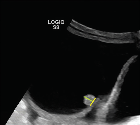 Ultrasonography (USG) image shows a cystic lesion with a solid papillary projection. The height (green line) of the echogenic component has to be measured. If it measures 3 3 mm, then considered a solid component if it measures < 3 mm in height then considered as part of the irregularity of the wall.