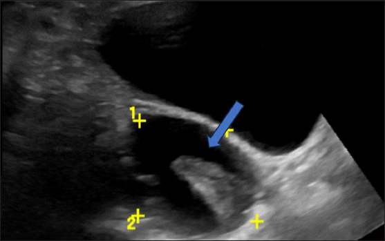 Ultrasonography (USG) image shows a typical hemorrhagic cyst. A unilocular cyst with a retracted clot showing an acute margin appearing as avascular tissue (blue arrow).