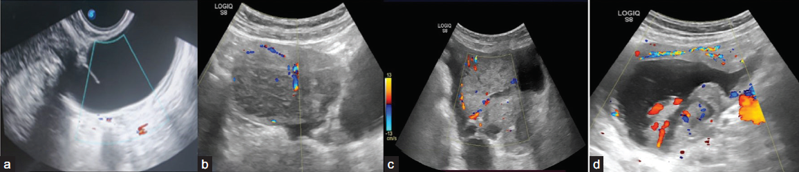 Ultrasonography (USG) images of various adnexal lesions with different color score patterns: (a)-color score 1, (b) color score 2, (c) color score 3, (d) color score 4