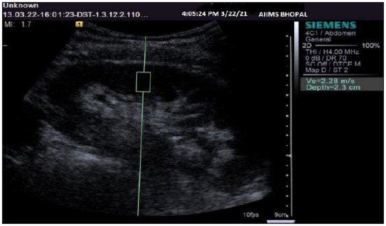 Ultrasonography gray-scale sagittal image of a kidney showing the method of region of interest cursor placement and obtaining shear wave velocity values.