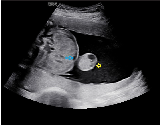 Midline anterior abdominal wall defect in fetus in umbilical region with herniation of fetal bowel loops, covered by a membrane, suggesting omphalocele. Blue arrow showing a defect in the umbilical region. Yellow arrow showing hernial sac with bowel loops as content.