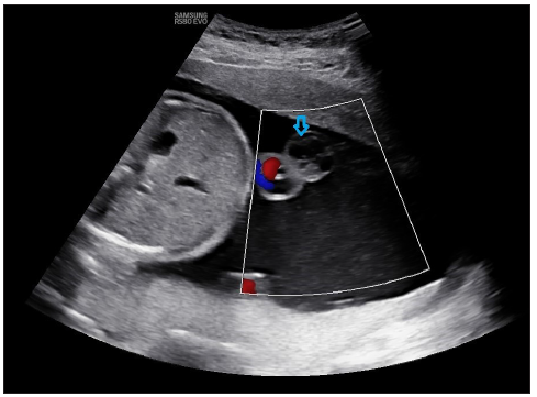 Cystic lesion (blue arrow) is seen arising from the umbilical cord, suggesting an umbilical cord cyst, which does not show vascularity on color doppler imaging.