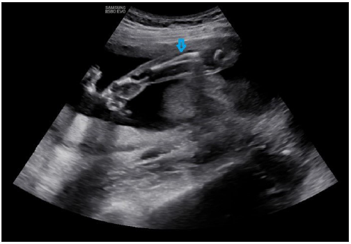 (blue arrow) Radius and ulna, which were short for gestational age (19 weeks ±two days) as measured by Merz and Jeanty formula suggesting Mesomelia.
