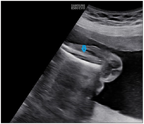 (blue arrow) Tibia and fibula, which were short for gestational age (19 weeks ±two days) as measured by Merz and Jeanty formula suggesting Mesomelia.