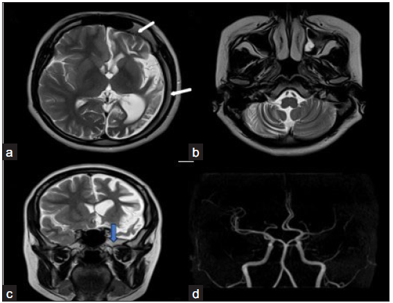 Dyke–Davidoff–Masson syndrome. (a) T2 axial image shows left cerebral hemiatrophy predominantly involving the perisylvian and temporal region with ex vacuo dilation of the left lateral ventricle. (b) shows hemiatrophy of contralateral cerebellum-crossed cerebellar diaschisis. (c) psilateral calvarial thickening (white arrow) and elevation of the greater wing of the left sphenoid (blue arrow) are seen. Middle cerebral artery Time of Flight (TOF) image (d) shows mild paucity in left Middle cerebral artery (MCA) cortical branches, however internal cerebral artery (ICA) appears normal.
