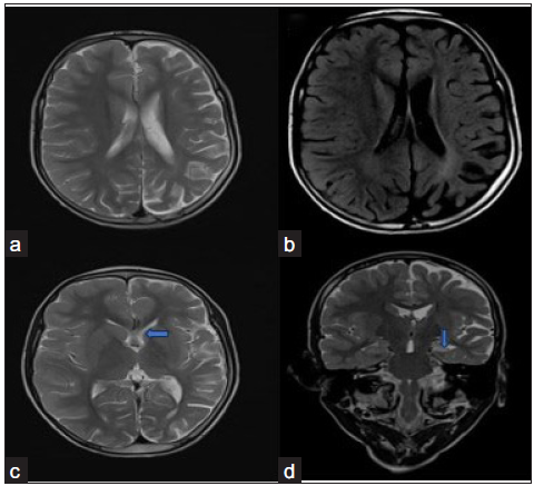 Rasmussen’s encephalitis. (a) T2 axial (a) image shows mild left cerebral hemiatrophy. (b) There is a mild hyperintense signal seen in the gray and white matter in the fluid-attenuated inversion recovery (FLAIR) axial image. (blue arrow in c) The left caudate nucleus shows mild atrophy. (blue arrow in d) There is also atrophy with altered T2 hyperintense signal seen in the left hippocampus. No contrast enhancement is seen. No compensatory bony calvarial hypertrophy is seen.