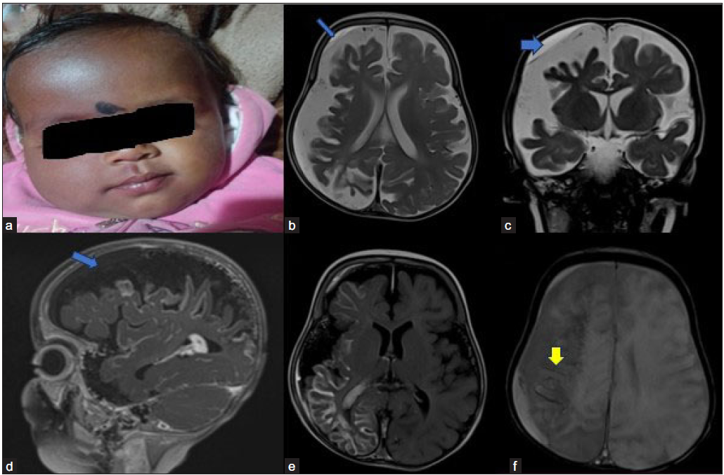 Sturge–Weber syndrome. Image 1a shows a port wine stain on the right-side face. (3b and 3c blue arrows) Moderate diffuse (with parieto-occipital predominant) right cerebral hemiatrophy seen with mild left cerebral hemiatrophy. (3d blue arrow and 3e) Post-contrast T1 sagittal Fluid-Attenuated Inversion Recovery (FLAIR) axial images show diffuse leptomeningeal enhancement on the right side of the hemisphere. A mild subdural hemorrhage is seen on the right side (blue arrows). (3f) Susceptibility weighted imaging (SWI) image (yellow arrow) shows blooming in the subcortical area on the right side, which is on CT correlation, is suggestive of calcification.
