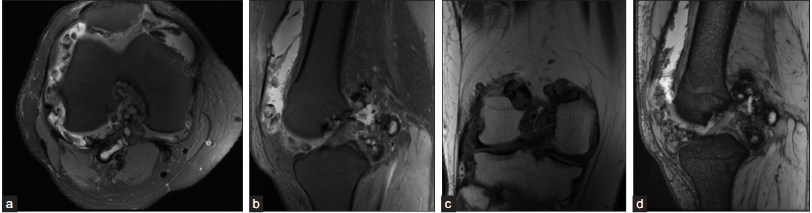 (a-b) A 26-year-old male presented with right knee pain and swelling for one year. T2FS axial and sagittal images and (c) T1 coronal image show moderate joint effusion, and synovial proliferation with multiple synovial based nodular deposits. These deposits show central, intermediate, and peripheral hypointense signals on both T1 and T2. (d) On gradient Multiple echo recombined gradient echo MERGE sequence, they are showing blooming at the periphery, which is characteristic of pigmented villonodular synovitis (PVNS). The synovial deposits did not show any evidence of mineralization on radiographs (not shown).