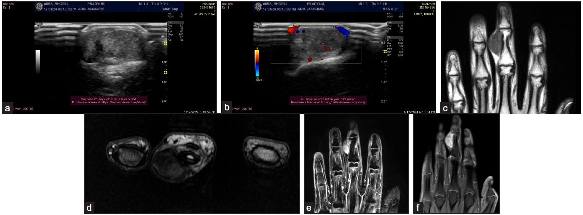 A 27-year-old male complains of painless swelling at the ulnar aspect of the third digit of his right hand. (a-b) (ultrasound images) show a well-defined heterogeneous hypoechoic lesion with mild internal vascularity. (c) (coronal T1WI) shows a well-defined intermediate signal lesion involving the palmar and ulnar aspects of the right third digit. On the Axial T2W image (d), the lesion shows hypointense to intermediate signal and appears adherent to the adjacent flexor tendon sheath. The coronal 3D MERGE sequence (e) demonstrates smooth scalloping of the adjacent phalanx caused by the lesion (arrow). (f) Postcontrast coronal image shows moderate heterogeneous enhancement. Ultrasound guided fine needle aspiration cytology was done, which suggested the diagnosis of a Giant cell tumor of tendon sheath (GCTT).