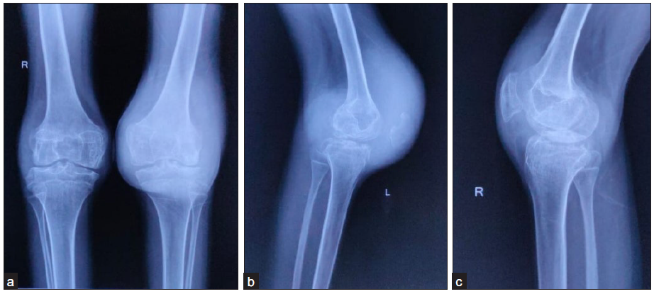 The frontal and lateral radiographs of both knees of a 16-year-old male with complaints of recurrent bilateral knee joint swelling. Factor VIII levels were found to be at 25% (normal range 50%–150%). (a-b) Frontal and lateral radiographs of the left knee, show large soft tissue density (due to joint effusion) with widening of intercondylar notch, mildly reduced joint space, and few small bony erosions at the tibial plateau and posterior surface of patella. (a-c) Frontal and lateral radiographs of the right knee show widened intercondylar notch and periarticular osteopenia. The soft tissue density is less remarkable as compared to the left knee.