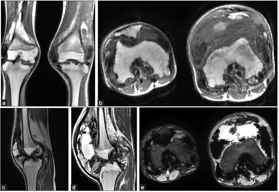 A 16-year-old male with complaints of recurrent bilateral knee joint swelling and decreased levels of Factor VIII. (a-b) Coronal and axial images of bilateral knee show areas of synovial proliferation causing erosions into the articular surface of adjacent bones. (c-d) Sagittal T2W images of the right and left knees show diffuse irregular, markedly hypointense thickening of the synovium, with distension of the suprapatellar recess of the left knee due to fluid. The fluid shows an intermediate signal on T1, indicating probable hemorrhagic composition. (e) On gradient sequences the thickened synovium shows marked blooming. Based on the clinical, radiographic, and MRI findings, a diagnosis of bilateral hemophilic arthropathy was made.