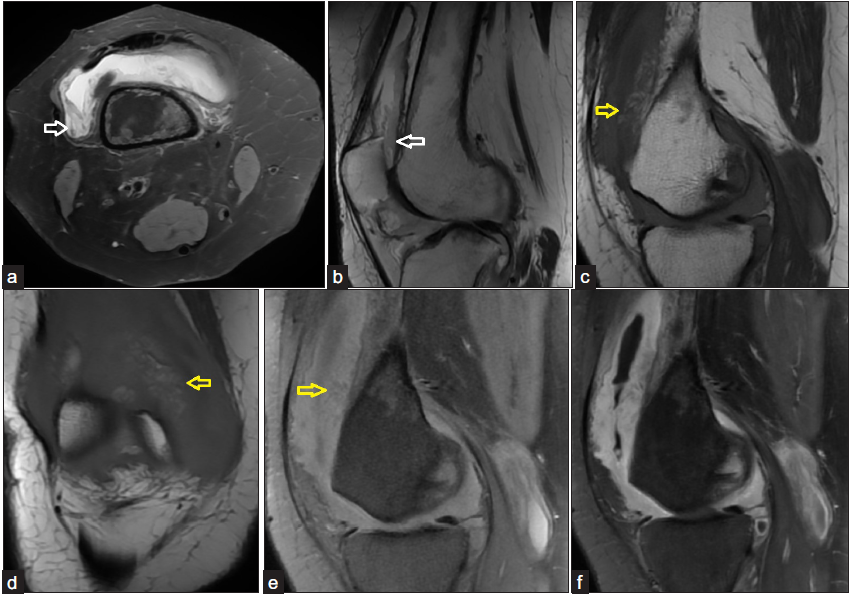 A 48-year-old female presented with right knee pain and swelling for one year. (a-b) Axial T2FS and sagittal T2 images show moderate joint effusion with synovial thickening (white arrow). (c-d) Sagittal and coronal T1 images show areas of hyperintense signal within the thickened synovium (yellow arrow), (e, yellow arrow) which showed complete loss of signal on fat-saturated T1 sequence. (f) Postcontrast T1FS sagittal scan showing homogeneous enhancement of the thickened synovium. The findings of synovial proliferation with areas of fat signal intensity within are characteristic of lipoma arborescens.