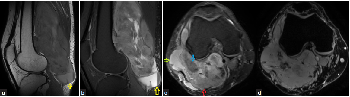 A 30-year-old male presented with swelling and pain in the popliteal fossa for two years. The swelling was initially pea-sized, which then progressed insidiously to the current size. (a yellow arrow and b) Sagittal T1 and PDFS sequences show a large, well-defined multilobulated solid mass in the popliteal fossa, which shows heterogeneous intermediate signal intensity on both T1 and PDW images. There is also a loculus showing a fluid hemorrhagic level within, seen at the inferior end of the lesion (yellow arrow), which represents intralesional hemorrhage. Few other similar fluid-hemorrhagic levels were also noted. (c-d) Axial T2FS and gradient image show three areas of contrasting signal intensities, with cystic or necrotic areas appearing hyperintense (green arrow), solid components appearing intermediate (red arrow), and areas of mineralization showing hypointense signal (blue arrow) with blooming, on gradient sequences. This is referred to as a “Triple Sign” due to the presence of three areas of distinct signal intensity within the same lesion. Histopathology showed mild to moderately pleomorphic, oval to spindle shaped cells positive for SS18 and SMA, and a diagnosis of monophasic synovial sarcoma was given.