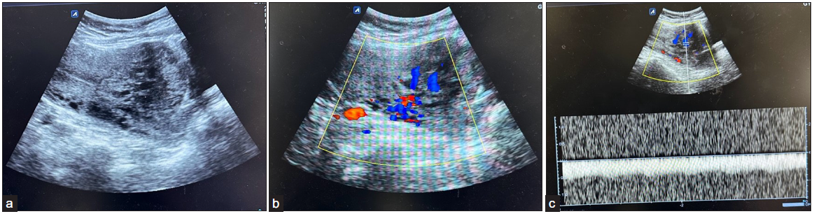 (a) Ultrasound image showing 4.3 ´ 3.8 cm heterogeneous mass with multiple serpentine cystic spaces in anterior myometrium lower uterine segment close to previous cesarean scar site. (b) Color Doppler image shows high vascularity of the mentioned lesion, which shows high PSV and low RI waveform pattern, (c) suggesting the high-flow AVM component. PSV: Peak Systolic Velocity, RI: Resistive Index, AVM: Arterio-Venous Malformation.