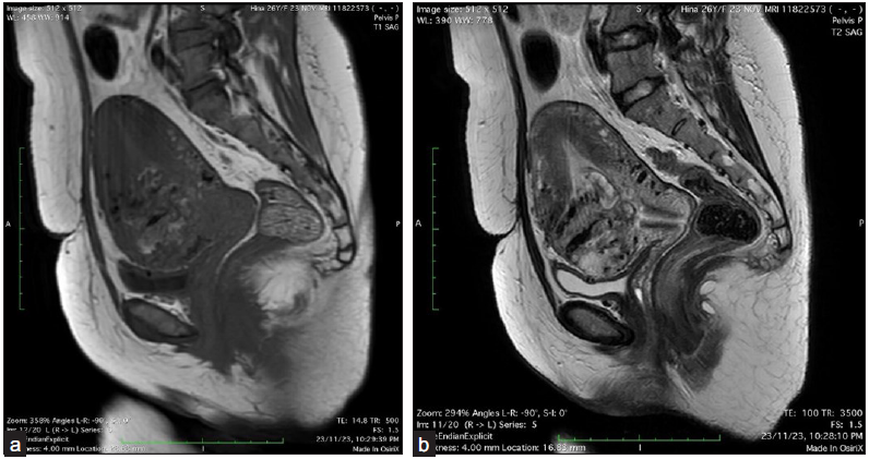 (a) MRI pelvis shows an ill-defined T1 mixed and T2/short TI inversion recovery (STIR) heterogeneous hyperintense and, (b) mass lesion with multiple serpiginous T1 and T2 hypointense flow voids involving the lower uterine segment at previous cesarean scar site in anterior myometrium. STIR: short TI inversion recovery.