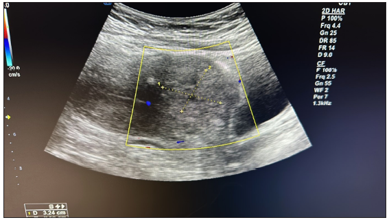 Follow-up ultrasound after 30 days of intervention suggested a reduced size of the space-occupying lesion without any significant vascularity.