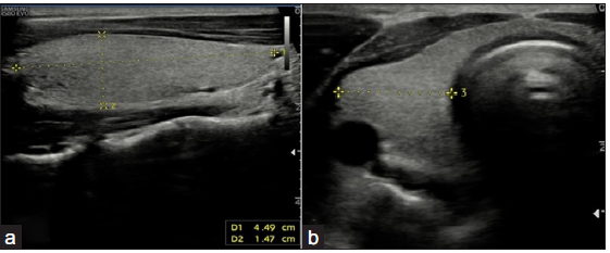 (a) B-mode ultrasound image of the thyroid gland in longitudinal and (b) transverse views showing the correct method of measurements for depth Anteroposterior (AP), width (transverse), and length (longitudinal) dimensions in centimeters (cm).