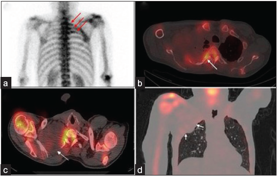 (a) Posterior planar spot view of the thorax shows increased tracer uptake in the right 1st–3rd ribs (red arrows), which on Single Photon Emission Computed Tomography (SPECT/CT) images corresponds to erosion of these ribs (b) (arrow in axial bone window image, (c) by soft tissue mass in the upper lobe of the right lung (arrows in axial image (d) and arrows in the coronal lung window image).