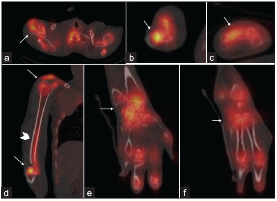 (Arrows in a–f) Axial, sagittal, and coronal hybrid Single Photon Emission Computed Tomography (SPECT-CT) images of the right upper limb show increased tracer uptake in shoulder and elbow joints and peri-articular uptake in small joints of the hand. (Arrowhead in d) Diffusely increased tracer uptake is also noted in the right humerus.