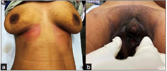(a) Shows a fully developed breast (Tanner stage 4). (b) shows a phallus length of 3 cm, labioscrotal forum was incomplete, and single genito-urinary opening.