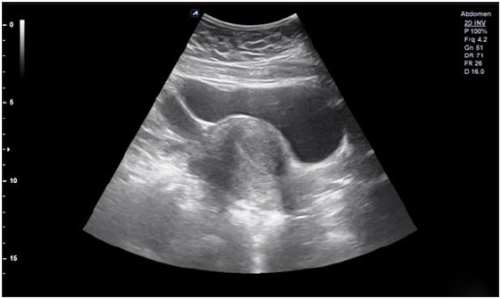Anteverted symmetric uterus with normal outer contour, normal size, echotexture, and endometrial thickness.