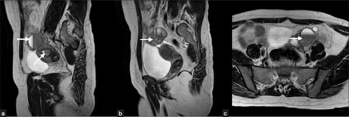 (a and b) Show a uterus with normal size, shape, and position with endometrial collection (arrow in 3a). (b and c) show bilateral endometriosis cysts (arrows in 3a, 3b, 3c).