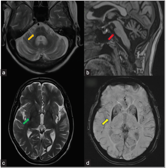 Showing Multiple system atrophy (a: Axial T2W at pons level, b: Mid Sagittal T1WI, c: Axial T2WI at ventricle level, d: Axial SWI). Images a and b show findings of Multiple system atrophy-cerebellum type (MSA-C) in the form of cruciform T2 hyperintensity in pons described as a hot cross bun sign (orange arrow in image a) and disproportionate pons, cerebellum, and middle cerebellar peduncle atrophy with relatively preserved midbrain volume (red arrow in image b). Images c and d show findings of MSA-P in the form of bilateral putaminal atrophy, hypointense signals on T2WI (green arrow in image c), and SWI blooming (yellow arrows in image d). There were also subtle rim T2 hyperintense signals in putaminal regions (better appreciated on the left side).