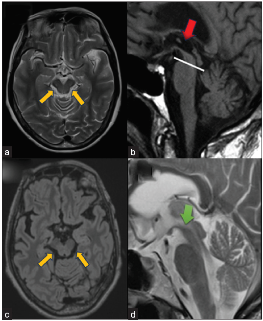 (a) MRPI and MRPI 2.0- Three-dimensional T1-weighted images. MRPI combines measurements of the midsagittal surfaces (yellow arrows) of the midbrain and pons and widths of the superior and middle cerebellar peduncles [MRPI = (pons/midbrain) × (middle cerebellar peduncle/superior cerebellar peduncle)]. (b) The limit between the midbrain and pons is defined by the line passing through the inferior border of the inferior colliculus and the ponto-mesencephalic sulcus. The inferior border of the pons is parallel to the previous one. The widths of the superior and middle cerebellar peduncles are measured in the parasagittal (red arrow) and (c) coronal planes (yellow arrows) that best show the peduncles, respectively. The MRPI 2.0 is the product of the MRPI by the ratio of the width of the third ventricle to the largest (d) left-to-right width of the frontal horns of the lateral ventricles (green arrow) on axial views.