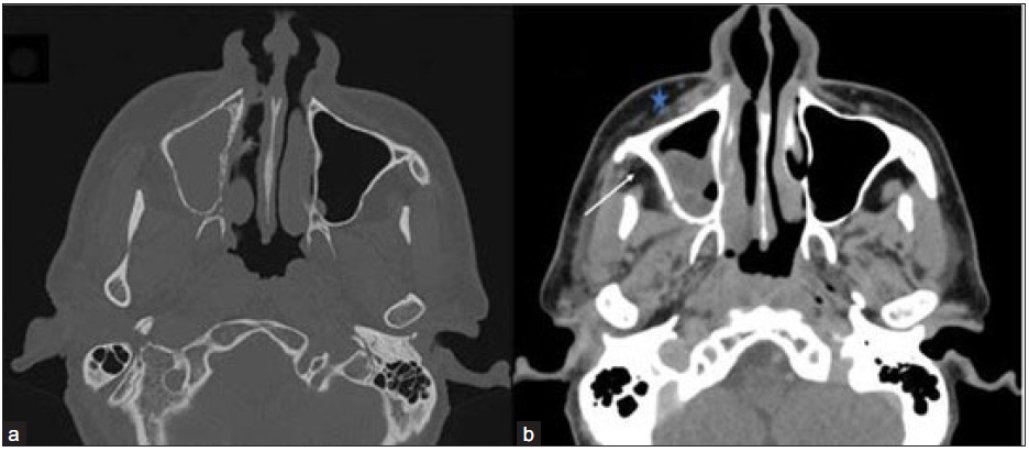 Axial non-contrast CT (NCCT) in the bone window (a) and contrast-enhanced CT (CECT) in soft tissue window (b) of the paranasal sinus of a 48-year-old male, post COVID with paresthesia in the right side of face depict hypodense mucosal thickening showing heterogenous enhancement in the right maxillary sinus. Bony rarefaction is noted in the medial wall of the right maxillary sinus, and minimal soft tissue thickening and stranding are observed in pre-maxillary (star) and retro-antral fat (arrow).