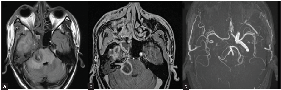 A 45-year-old male, post-COVID, with a history of altered sensorium. Axial FLAIR (a) and axial post-contrast fat-saturated T1-weighted (b) images depict a large area of FLAIR hyperintensity representing edema with peripheral rim enhancement within it in the right side of the pons, consistent with late cerebritis/ abscess stage. The right 7th/8th nerve complex is enhanced and thickened in the internal auditory canal. FLAIR hyperintensity is also seen in the right temporal lobe with heterogeneous enhancement. On TOF MR angiography images (c), the flow-related signal is absent in the right internal carotid artery (ICA). FLAIR = Fluid attenuation inversion recovery; TOF = Time of flight