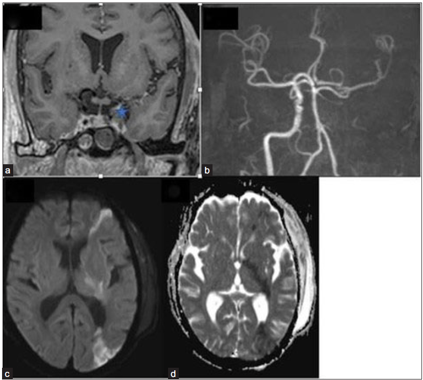 Coronal post-contrast fat, saturated T1-weighted image (a) depicts a bulky left cavernous sinus with a hypointense filling defect (star). 3-dimensional TOF MR angiography image (b) reveals the absence of flow-related signal in the left ICA with attenuation of its terminal branches. Axial DWI (c) and ADC image (d) show restricted diffusion in the left fronto-parietal region and internal capsule, suggesting acute watershed infarcts. TOF = Time of flight; ICA = Internal carotid artery; DWI = diffusion weighted imaging; ADC = apparent diffusion coefficient