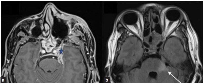 A 51-year-old male post-endoscopic debridement for sino-nasal mucormycosis with persistent headache with perineural involvement along the left trigeminal nerve. (a) Axial post-gadolinium fat-saturated T1-weighted image (star) and FLAIR image (b) reveal thickened and enhancing left trigeminal nerve (star) with FLAIR hyperintense signal in the pons and left middle cerebellar peduncle (arrow). Pachymeningeal enhancement is also noted along the left middle cranial fossa. Also, note the mucosal thickening and enhancement in the posterior ethmoidal and sphenoid sinuses. FLAIR = Fluid attenuation inversion recovery