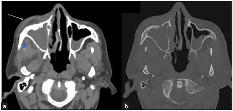 (a-b) Axial non contrast computed tomography (NCCT) images in soft tissue window and bone window of the paranasal sinus of a 42-year-old male, post COVID with swelling in the right side of the face reveals opacification of right maxillary sinus with soft tissue thickening in pre-maxillary (arrow) and retro-antral fat (star) No evidence of any bony changes noted in the walls of the right maxillary sinus.
