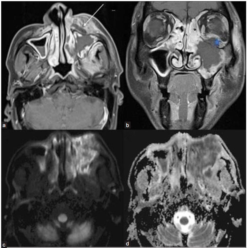 Post-COVID 60-year-old male with pain swelling on the left side of his face and reduced vision in the left eye. (a) Post-contrast fat-saturated T1-weighted axial (arrow) and coronal (b) images show non-enhancing necrotic areas in the left pre-maxillary region(arrow), left maxillary sinus mucosa, and in the intra-orbital soft tissue (star). Diffusion-weighted image/ DWI (c) reveals extensive areas of hyperintense signal in the left maxillary sinus mucosa and adjacent soft tissue with a corresponding drop on ADC image (d), suggesting necrosis or non-viable tissue. DWI = diffusion weighted imaging; ADC = apparent diffusion coefficient