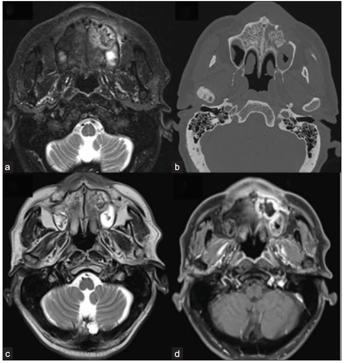 42-year-old male, post-COVID with facial pain. Axial T2-weighted (a), T1-weighted (b), and STIR (c) sequence of the paranasal sinuses depict T2 hyperintense, T1 hypointense mucosal thickening in the right maxillary sinus. T2 hypointense and T1 hyperintense areas are also present along the inner aspect of the mucosal thickening. The right retro-antral fat pad and the medial and lateral pterygoid muscles show STIR hyperintensity. (d) Post-contrast saturated T1-weighted coronal (star) and axial (e) images show heterogeneous mucosal enhancement in the right maxillary sinus. A confluent non-enhancing necrotic area is noted along the right middle and inferior turbinates, giving a ‘black turbinate sign’ (star). The right retro-antral region also has a patchy non-enhancing area (arrow). STIR = short tau inversion recovery