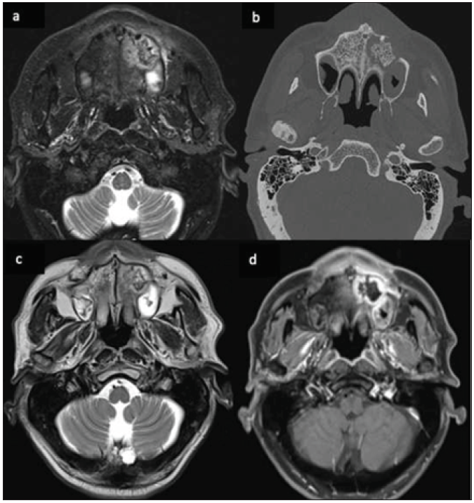 A 62-year-old male, post-COVID, with swelling in the upper alveolar region and left side of the face. Axial STIR image (a), Non contrast CT bone window image (b), and T2-weighted image (c) reveals ill-defined heterogeneous signal intensity in the left alveolar arch of the maxilla and adjacent part of the hard palate with central hypo-intensity corresponding to bone fragment. On post-contrast fat-saturated T1-weighted image (d), there is non-enhancement of this central bone fragment, suggesting osteonecrosis. STIR = short tau inversion recovery
