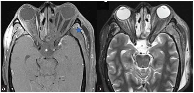 A 56-year-old male with black discoloration on the left side of his face and vision loss, loss of eye movements, and ptosis on day 20 post-COVID. Axial post-contrast fat-saturated T1-weighted (a) and STIR (b) images reveal non-enhancing left extra-ocular muscles and the intra & and conal fat, suggesting extensive devitalization and necrosis; right extraocular muscles show normal enhancement pattern. Also, note the tenting of the posterior wall of the left globe, suggesting raised intra-orbital pressure. Heterogeneously enhancing mucosal thickening in the bilateral ethmoidal air cells is also seen. Edema and a small area of non-enhancement are present in the left temporalis muscle fibers and adjacent scalp (star). The note is made of inhomogeneous fat suppression along the lateral aspect of the right orbit (a). STIR = short tau inversion recovery