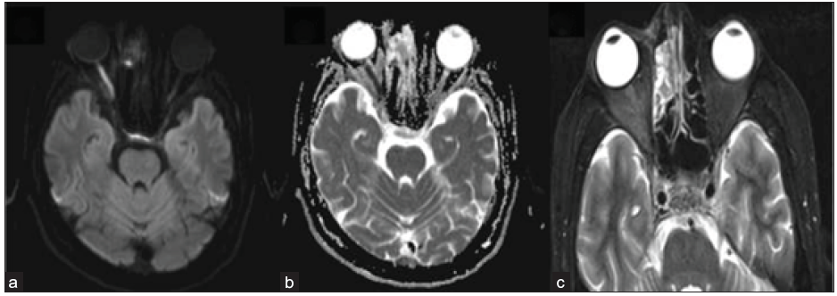 42-year-old male, day 10 post-COVID, with reduced vision in right eye. Axial DWI (a) reveals a hyperintense signal in the right optic nerve with a corresponding signal drop on ADC (b), suggesting diffusion restriction and ischemia. Axial STIR image (c) depicts right peri-optic fat stranding and heterogeneous mucosal hyperintensity in the right ethmoidal air cells. STIR = short tau inversion recovery; DWI = diffusion weighted imaging; ADC = apparent diffusion coefficient