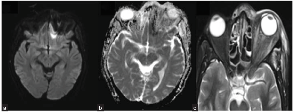A 49-year-old male with blackish discoloration on the left side of his face. Axial DWI (a) and ADC image (b) depict restricted diffusion in the left basi-frontal region (arrow). Axial STIR image (c) shows heterogeneous mucosal thickening in the ethmoidal air cells and inflammatory changes in the left pre-septal and intra-orbital soft tissue. DWI = Diffusion weighted imaging; ADC = Apparent diffusion coefficient, STIR = short tau inversion recovery