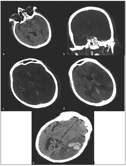 (a) NCCT head axial image of a 70-year-old male patient on initial presentation revealed a dense MCA sign on the left side and subtle hypoattenuation & sulcal effacement of the ipsilateral cerebral hemisphere. (b) CT angiography revealed non-opacification of contrast in the M1 & M2 segment of left MCA on coronal MIP reformat image. (c) Axial sections of arterial and (d) venous phase images revealed collateral status of 1, 1, and 1, respectively, as per Tan, Menon (sCT), and Menon (mCT) scoring systems. (e) Follow-up axial CT image revealed hemorrhagic transformation. The final mRS of the patient was 6. [MCA: Middle Cerebral Artery, MIP: Maximum Intensity Projection]