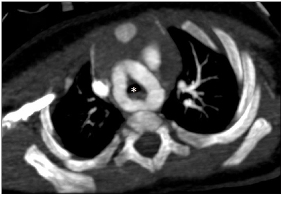 Computed tomography angiography (CTA) axial oblique image showing the double aortic arch forming a complete ring around the trachea (white asterisk).