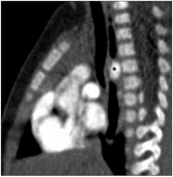 Computed tomography angiography (CTA) sagittal image showing severe compression of the esophagus by the double aortic arch (black asterisk)